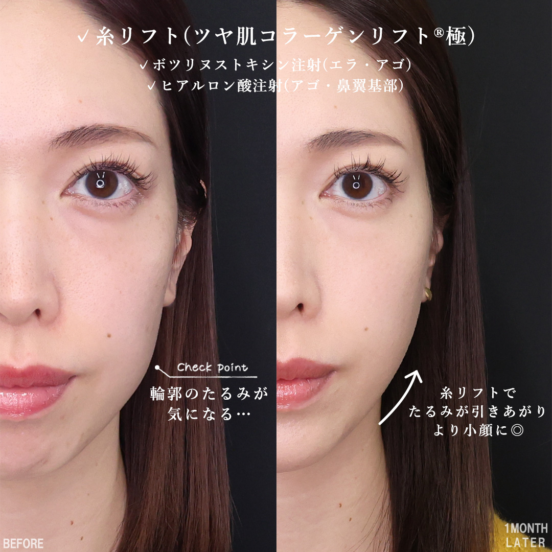 TAC式 ツヤ肌コラーゲンリフト®/顎のヒアルロン酸注射/エラボトックス注射の症例写真 施術前後