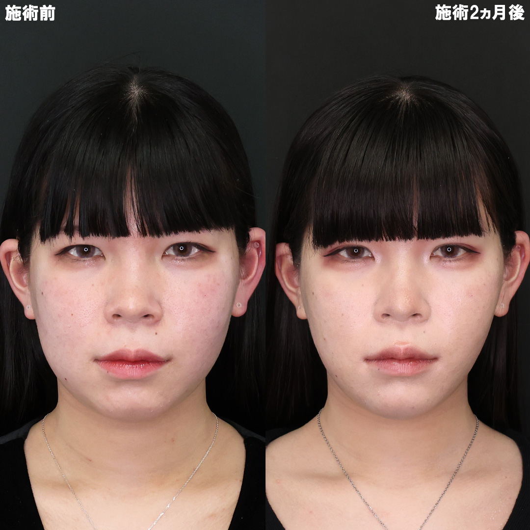 【脂肪除去＋糸リフト】理想のフェイスラインに