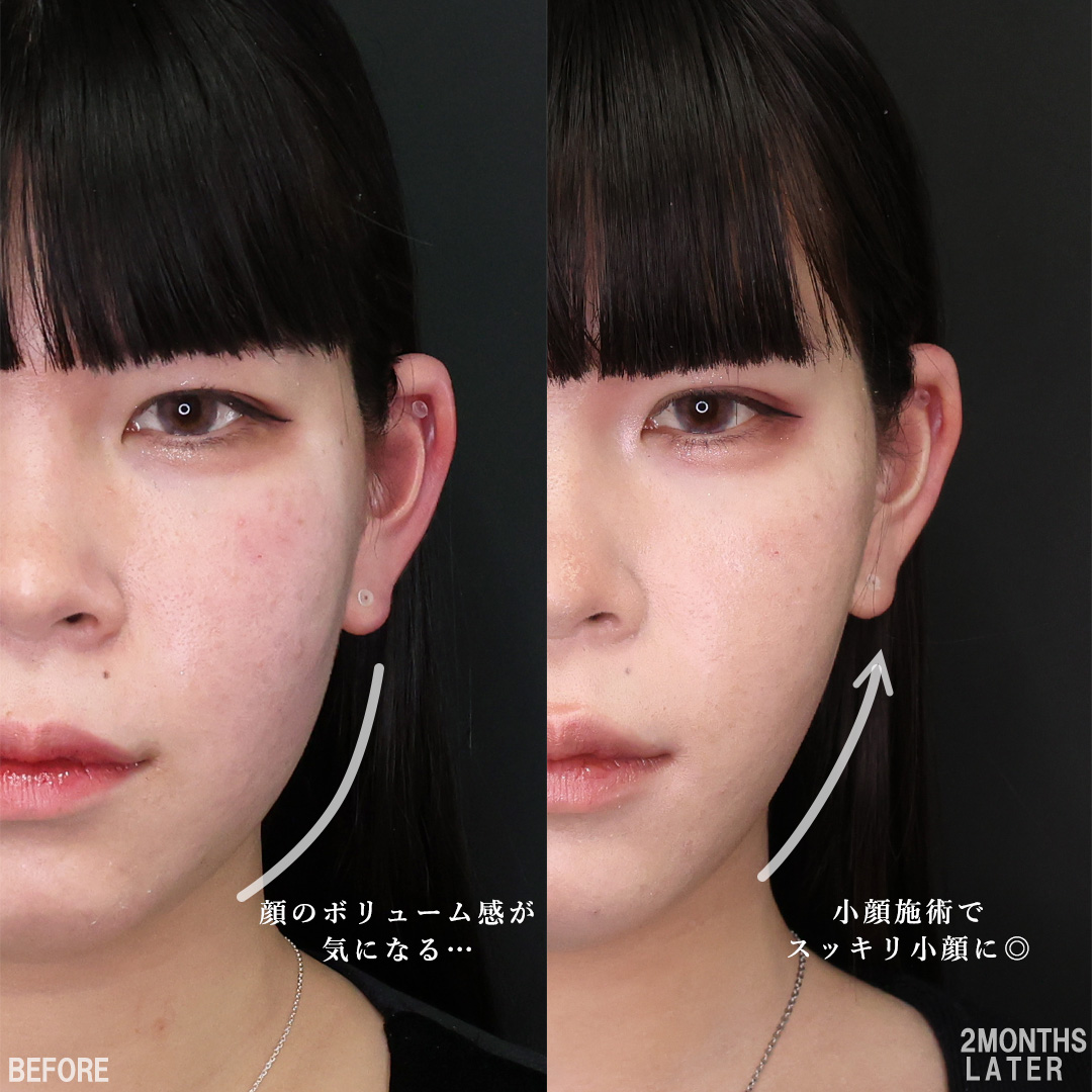 TAC式 ツヤ肌コラーゲンリフト®/Lラインファット除去（エラ下脂肪除去）/バッカルファット除去の症例写真 施術前後 