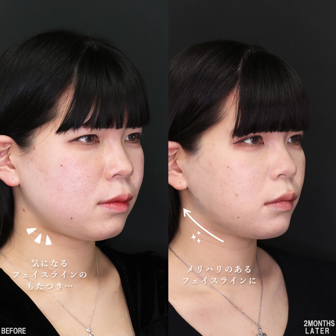 TAC式 ツヤ肌コラーゲンリフト®/Lラインファット除去（エラ下脂肪除去）/バッカルファット除去の症例写真 施術前後 