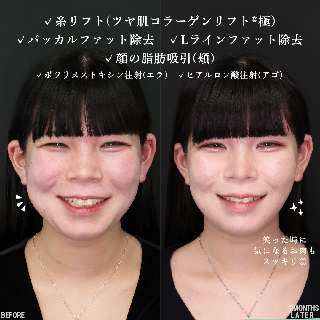 TAC式 ツヤ肌コラーゲンリフト®/Lラインファット除去（エラ下脂肪除去）/バッカルファット除去の症例写真 施術前後 