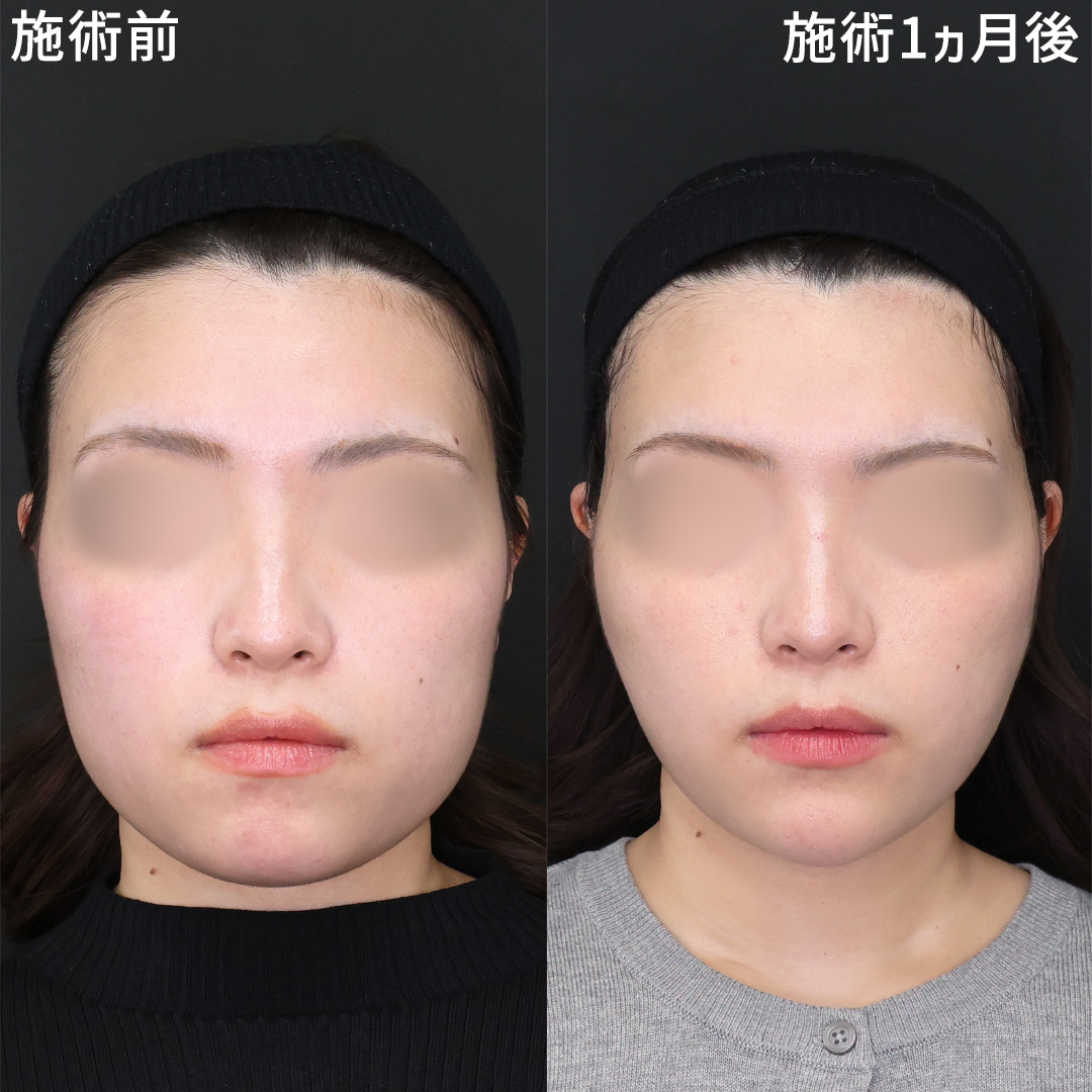 【小顔整形】四角い顔をスッキリ改善！脂肪吸引×糸リフト