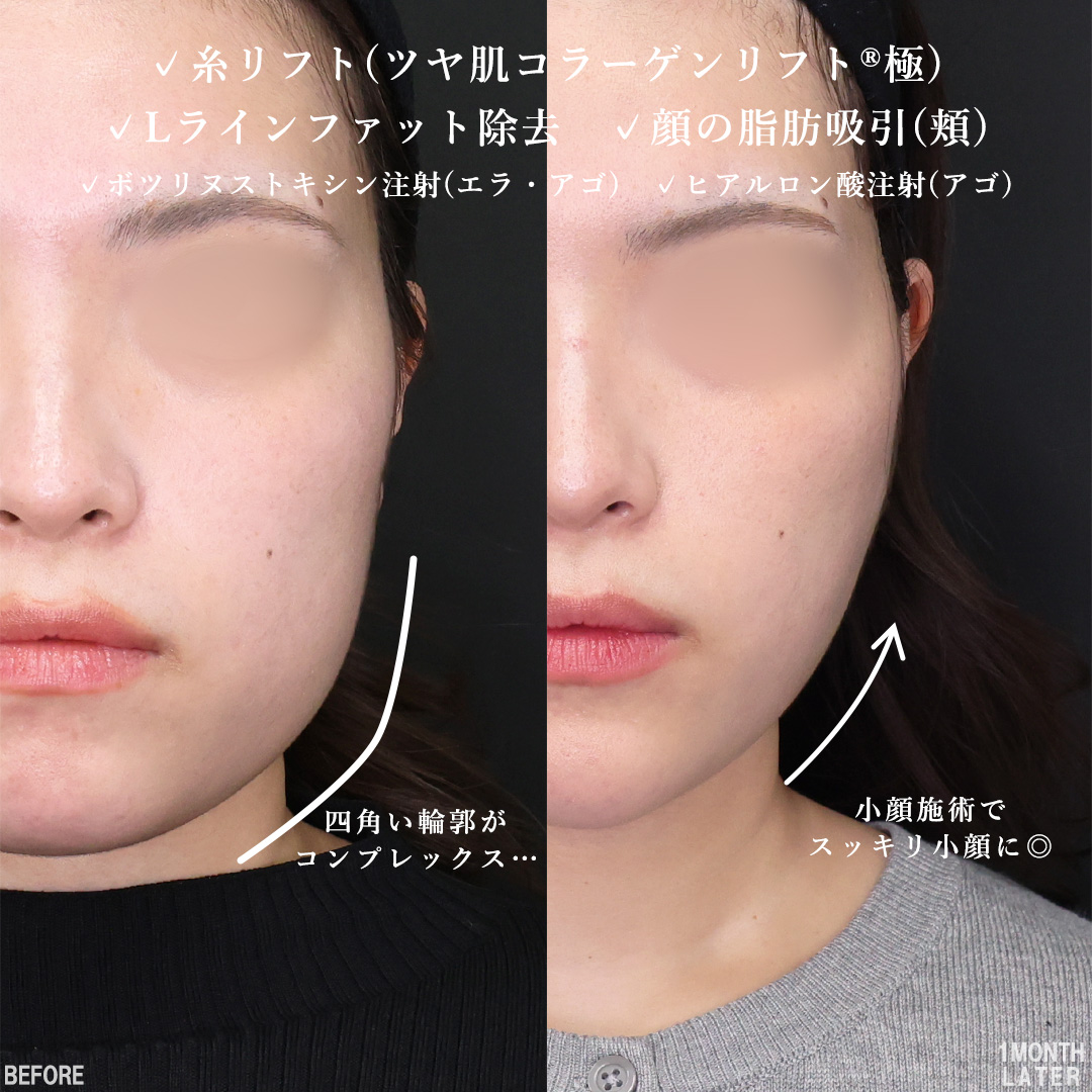 TAC式 ツヤ肌コラーゲンリフト®/顔の脂肪吸引/Lラインファット除去（エラ下脂肪除去）の症例写真 施術前後 