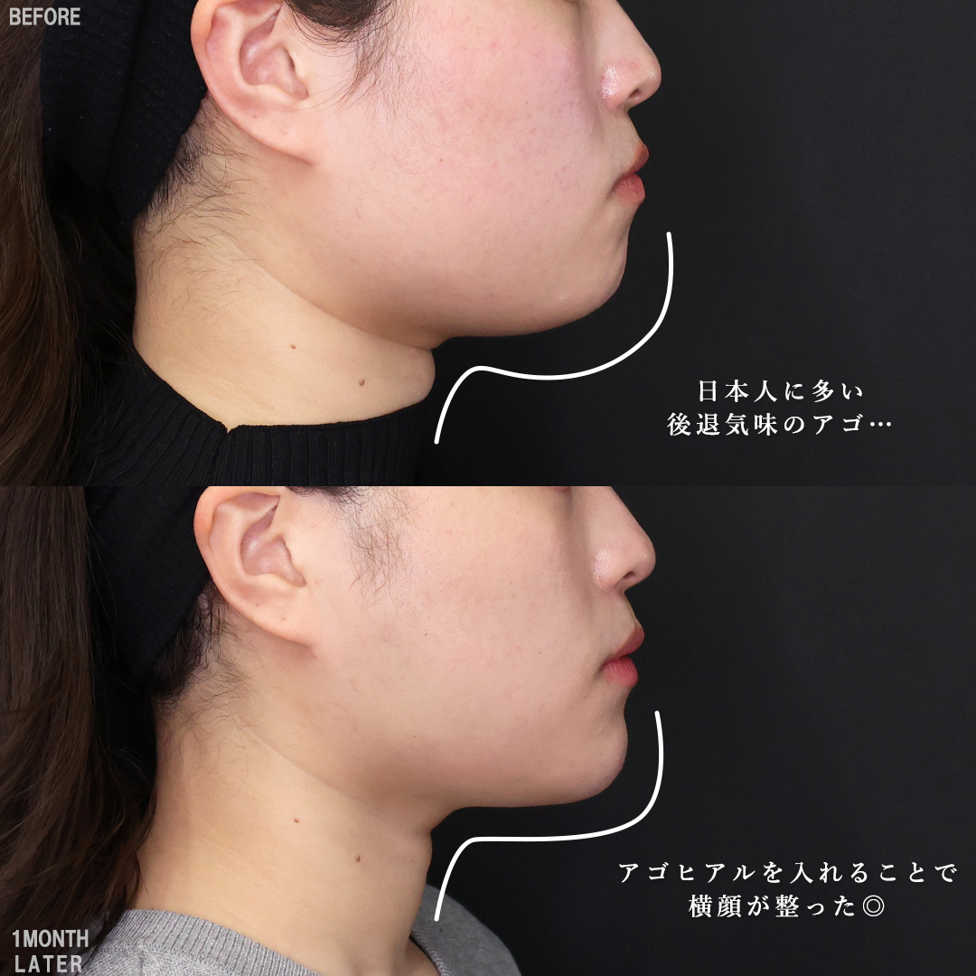 TAC式 ツヤ肌コラーゲンリフト®/顔の脂肪吸引/Lラインファット除去（エラ下脂肪除去）の症例写真 施術前後 