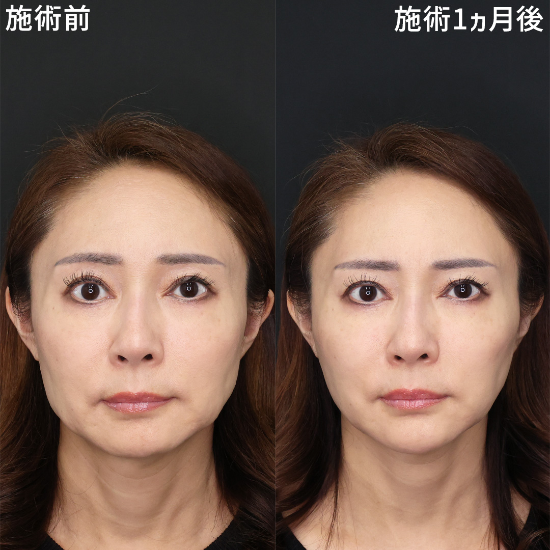 【50代たるみ改善】糸リフト×ショッピングリフトで-5歳！若返り施術で自信を取り戻す