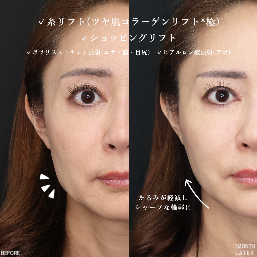 TAC式 ツヤ肌コラーゲンリフト®/TAC式 ショッピングリフト/おでこボトックス注射の症例写真 施術前後 