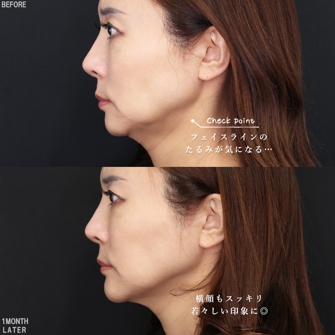 TAC式 ツヤ肌コラーゲンリフト®/TAC式 ショッピングリフト/おでこボトックス注射の症例写真 施術前後 