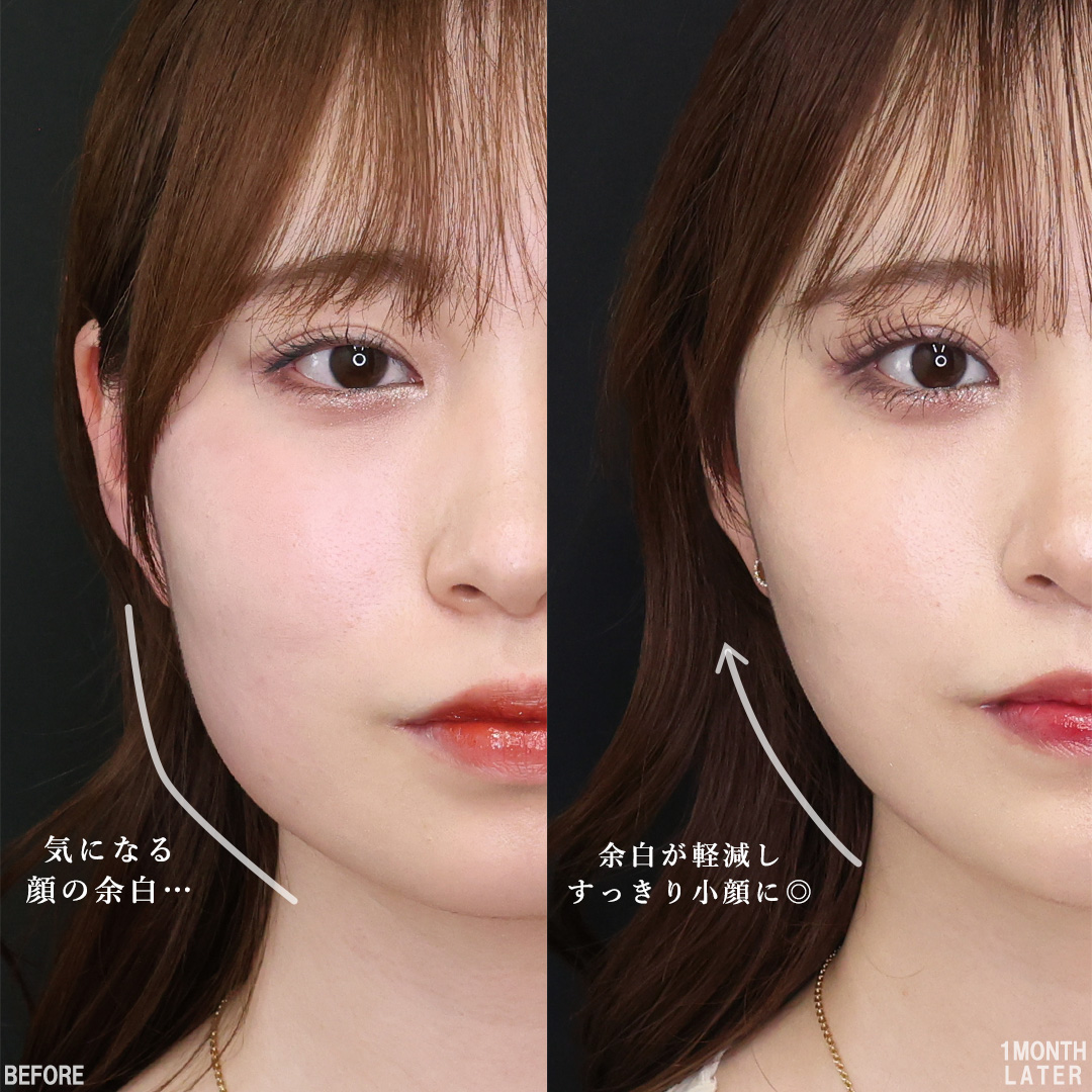 TAC式 ツヤ肌コラーゲンリフト®/バッカルファット除去/Lラインファット除去（エラ下脂肪除去）の症例写真 施術前後 