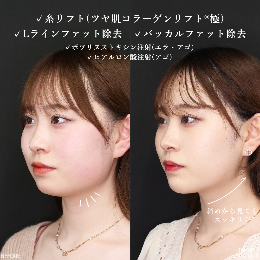 TAC式 ツヤ肌コラーゲンリフト®/バッカルファット除去/Lラインファット除去（エラ下脂肪除去）の症例写真 施術前後 