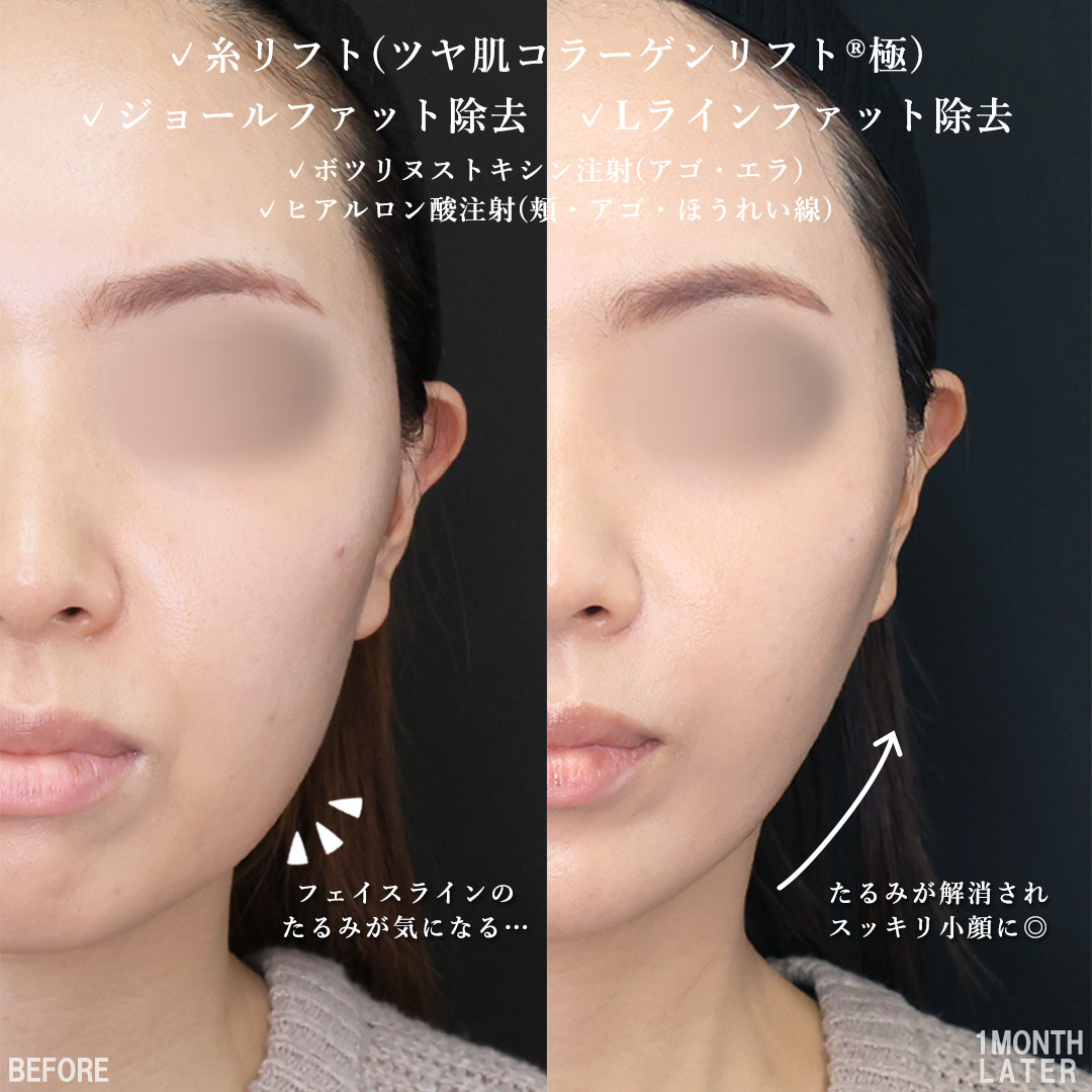 TAC式 ツヤ肌コラーゲンリフト®/Lラインファット除去（エラ下脂肪除去）/ジョールファット除去の症例写真 施術前後 