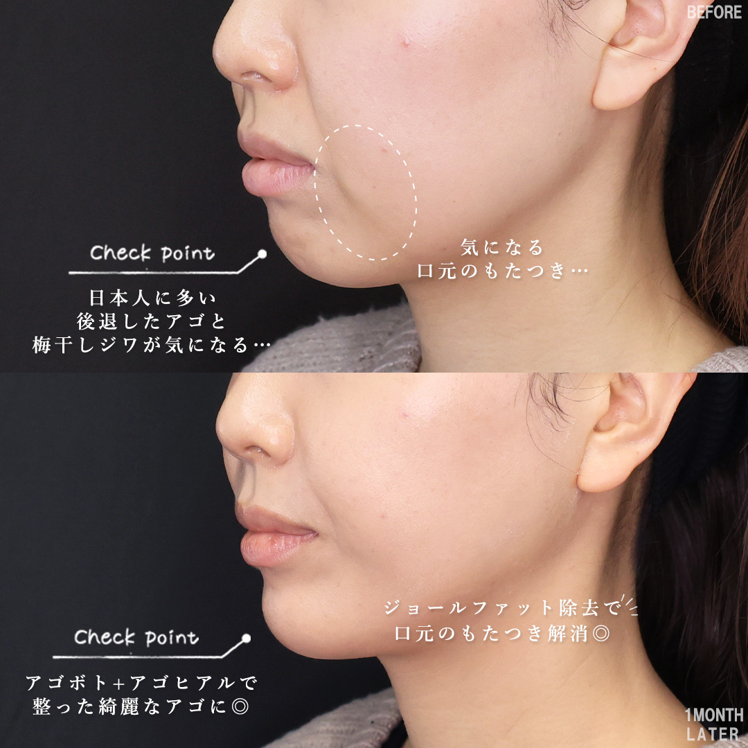 TAC式 ツヤ肌コラーゲンリフト®/Lラインファット除去（エラ下脂肪除去）/ジョールファット除去の症例写真 施術前後 