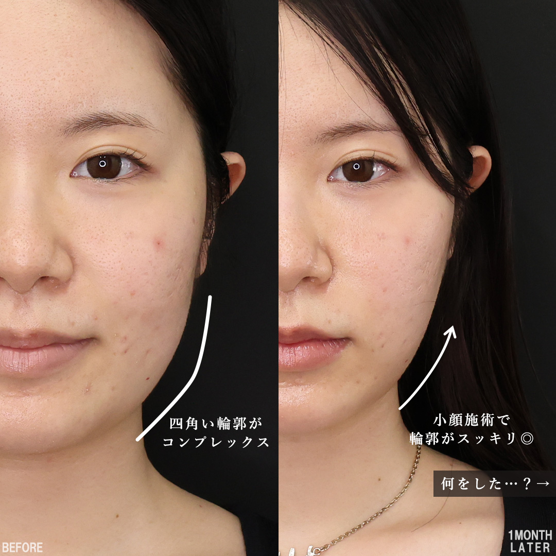 TAC式 ツヤ肌コラーゲンリフト®/Lラインファット除去(エラ下脂肪除去)/顔の脂肪吸引の症例写真 施術前後