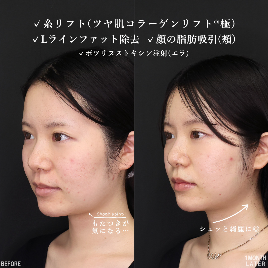 TAC式 ツヤ肌コラーゲンリフト®/Lラインファット除去(エラ下脂肪除去)/顔の脂肪吸引の症例写真 施術前後