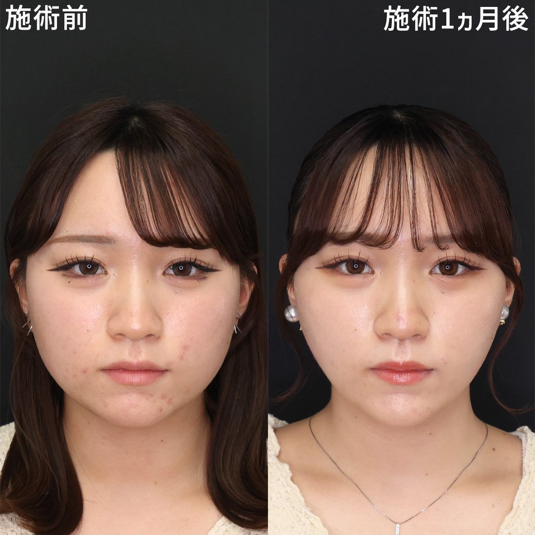 TAC式 ツヤ肌コラーゲンリフト®/顔の脂肪吸引/Lラインファット除去(エラ下脂肪除去)の症例写真 施術前後