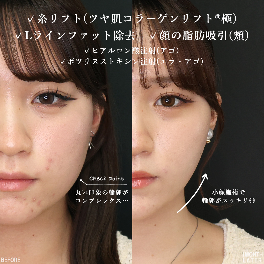 TAC式 ツヤ肌コラーゲンリフト®/顔の脂肪吸引/Lラインファット除去(エラ下脂肪除去)の症例写真 施術前後