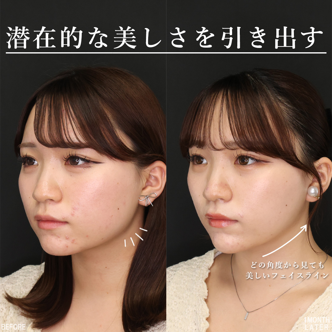 TAC式 ツヤ肌コラーゲンリフト®/顔の脂肪吸引/Lラインファット除去(エラ下脂肪除去)の症例写真 施術前後