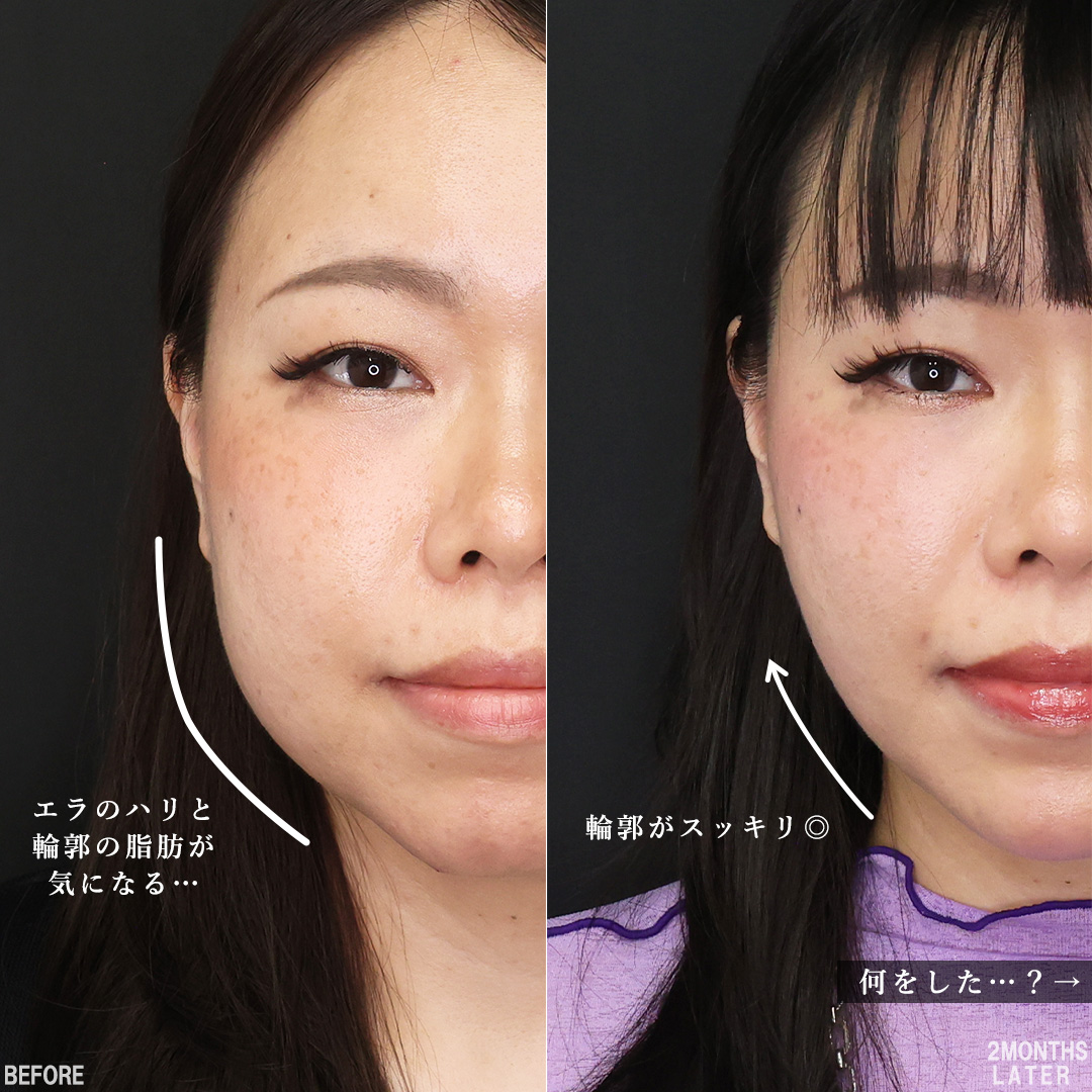 TAC式 ツヤ肌コラーゲンリフト®/顔の脂肪吸引/バッカルファット除去の症例写真 施術前後