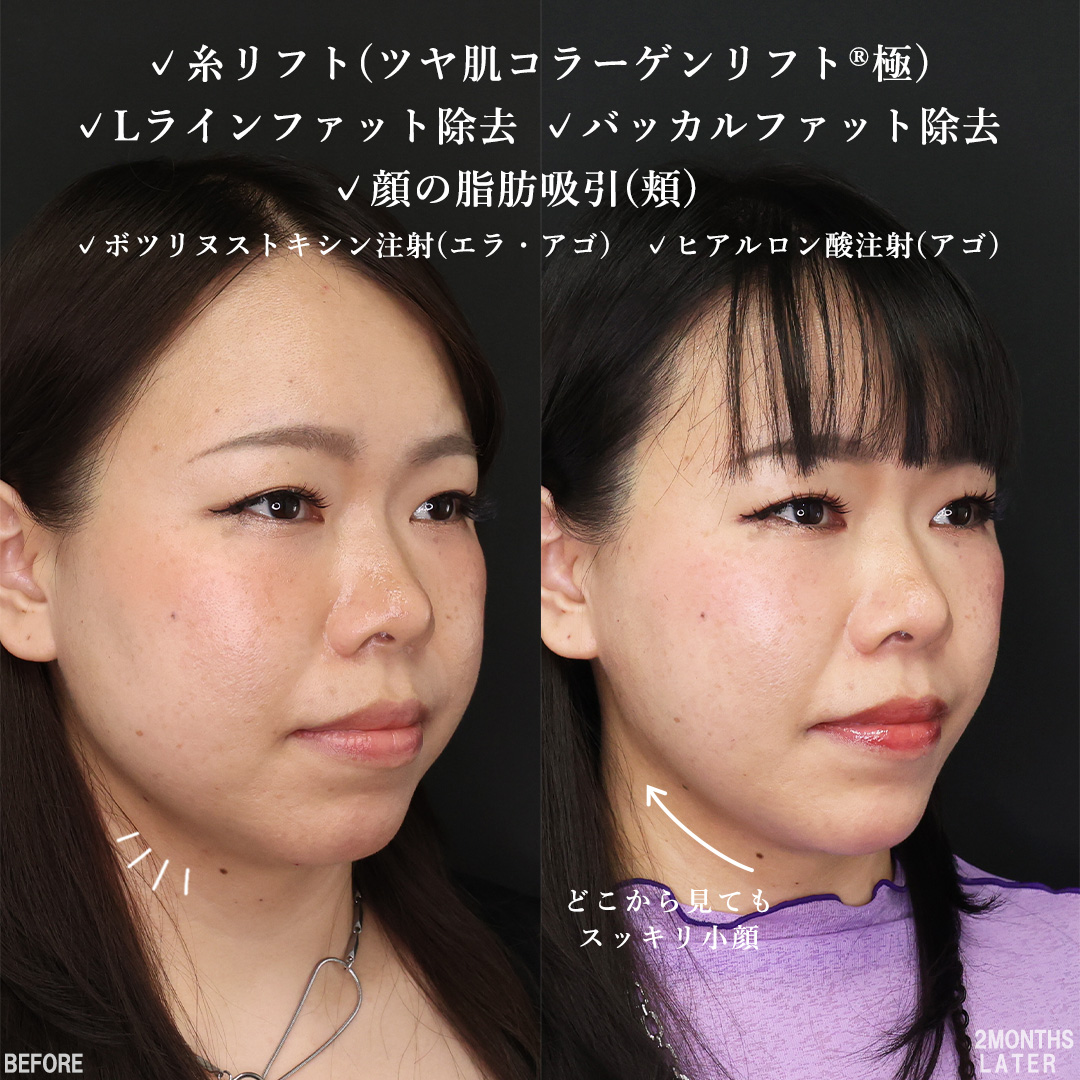 TAC式 ツヤ肌コラーゲンリフト®/顔の脂肪吸引/バッカルファット除去の症例写真 施術前後