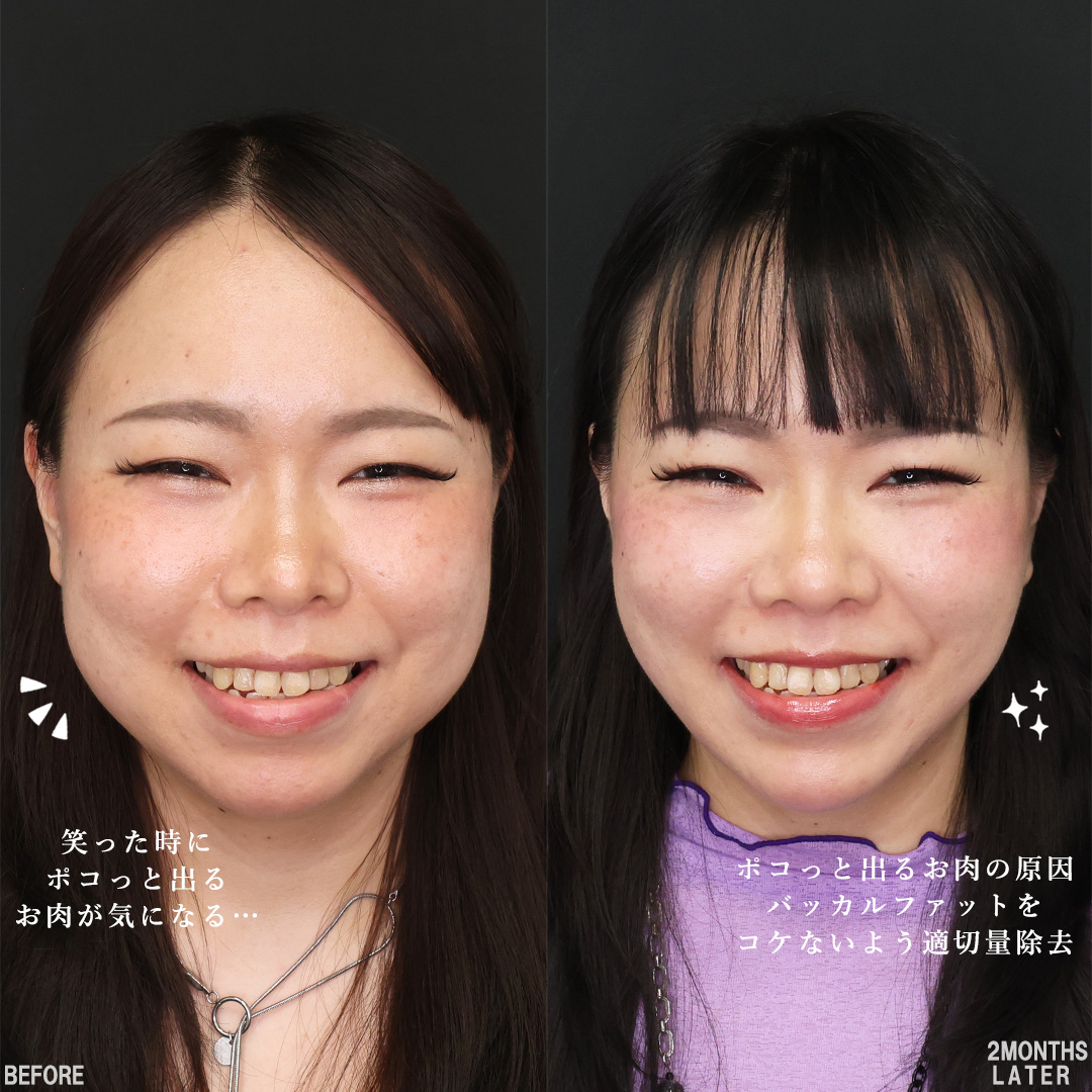 TAC式 ツヤ肌コラーゲンリフト®/顔の脂肪吸引/バッカルファット除去の症例写真 施術前後