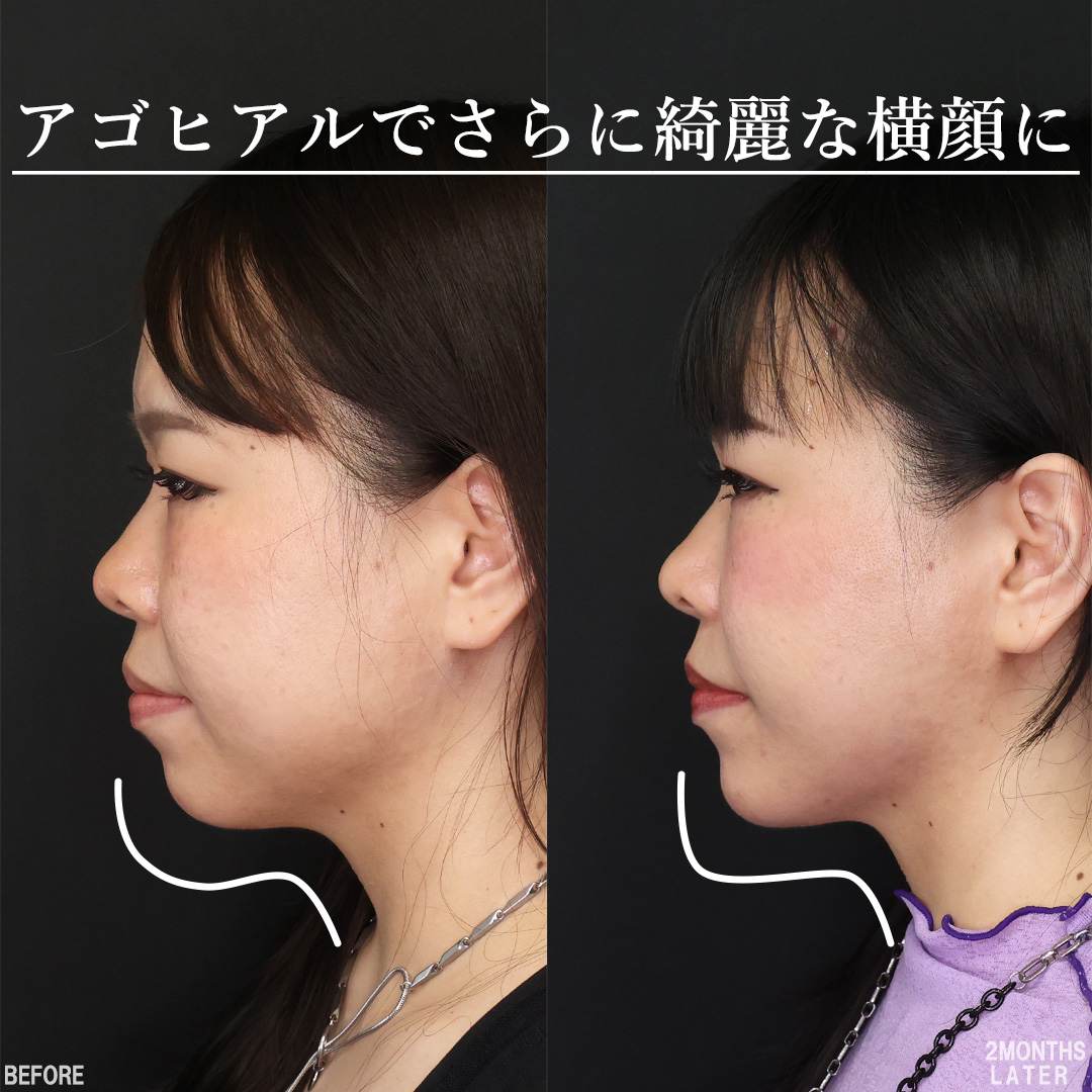 TAC式 ツヤ肌コラーゲンリフト®/顔の脂肪吸引/バッカルファット除去の症例写真 施術前後