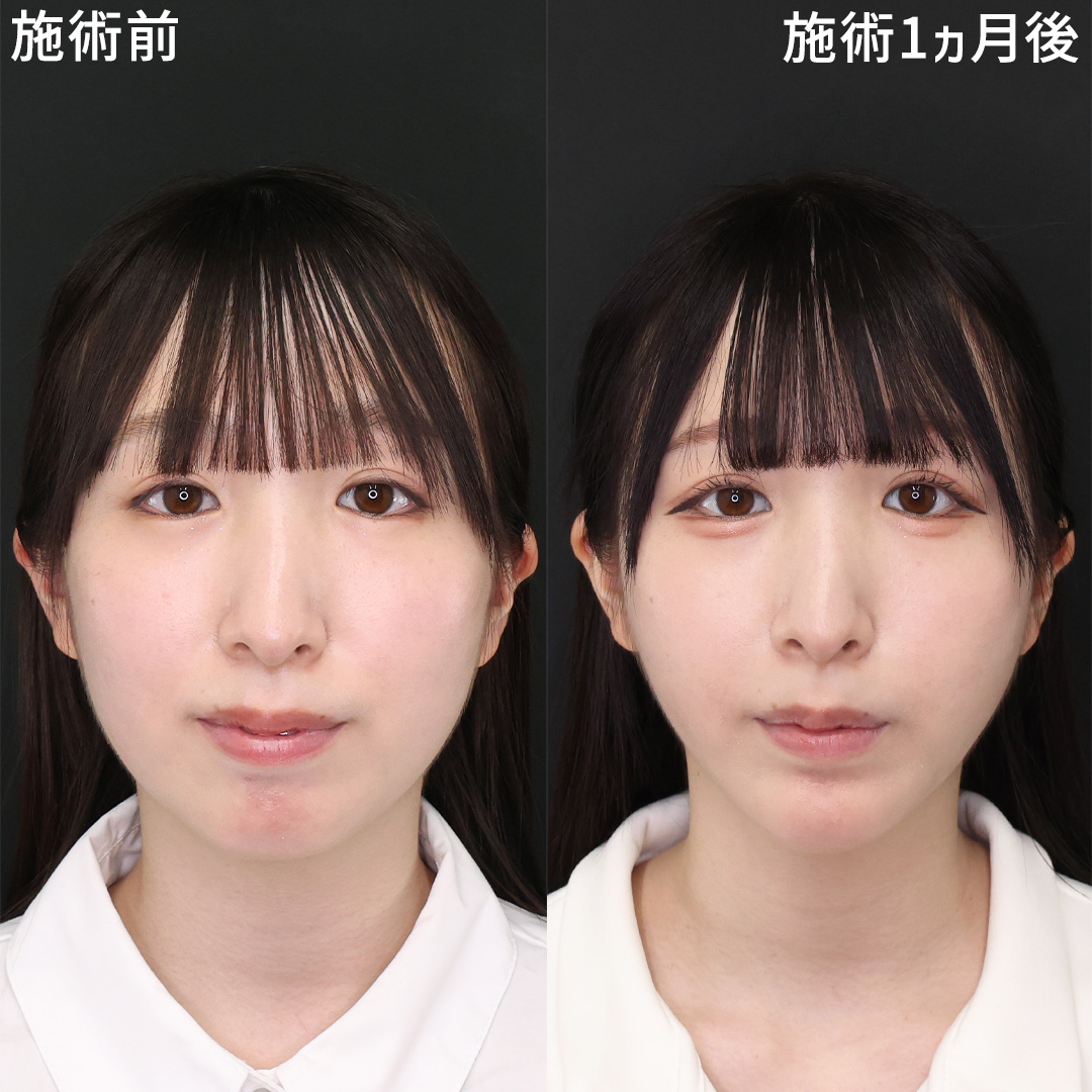 目 上 たるみ 新宿の症例写真・画像・ビフォーアフター｜美容