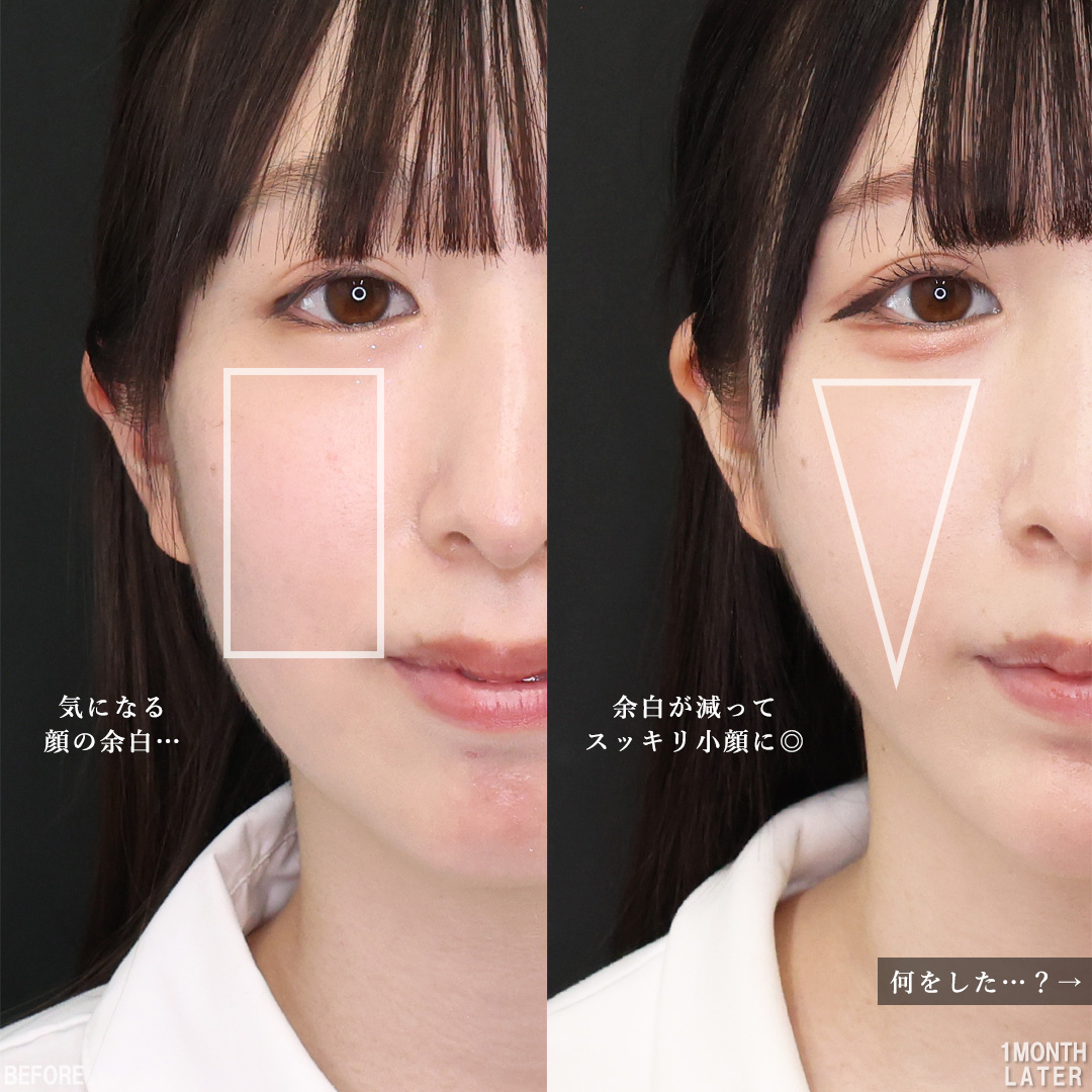 TAC式 ツヤ肌コラーゲンリフト®/Lラインファット除去（エラ下脂肪除去）/ジョールファット除去の症例写真 施術前後 