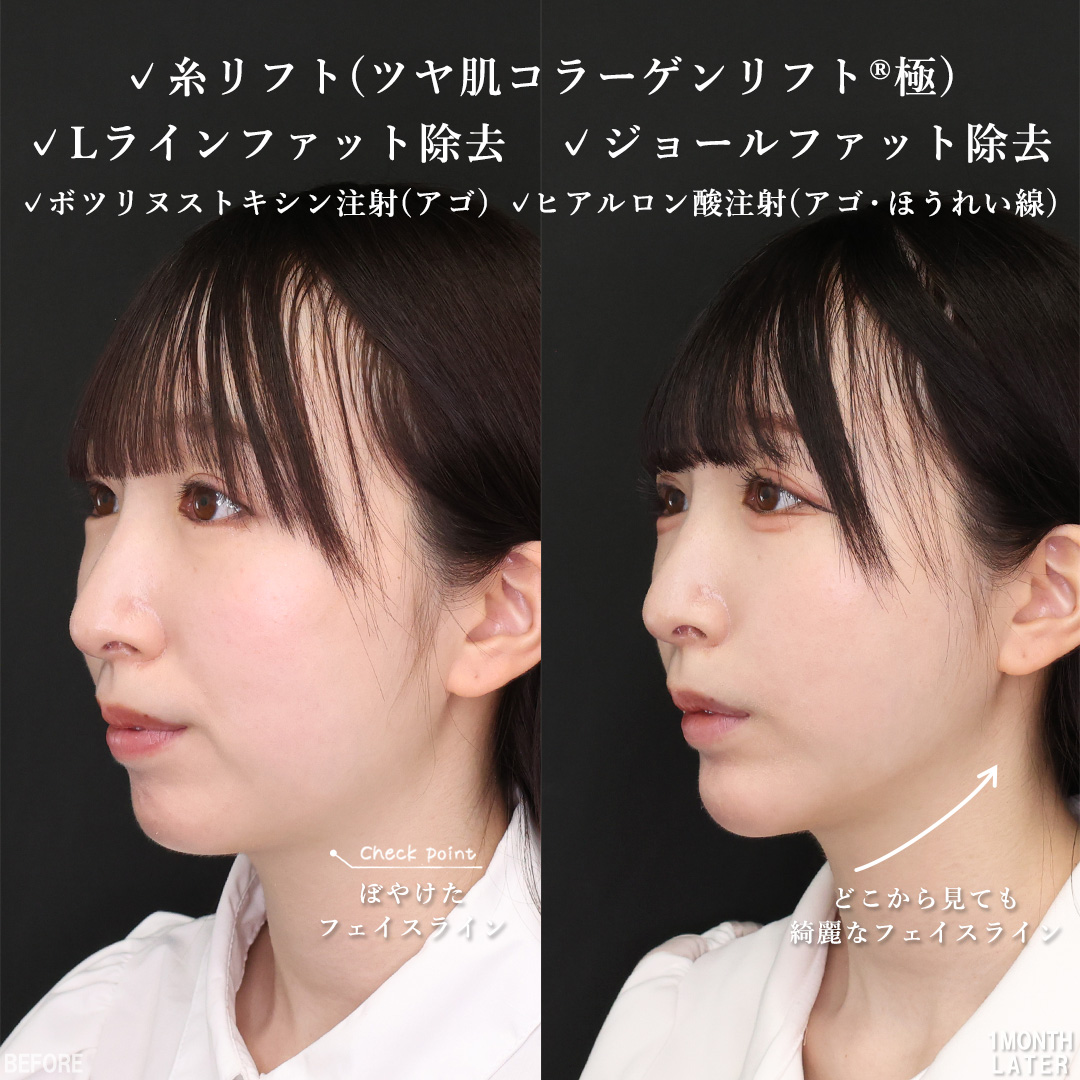 TAC式 ツヤ肌コラーゲンリフト®/Lラインファット除去（エラ下脂肪除去）/ジョールファット除去の症例写真 施術前後 