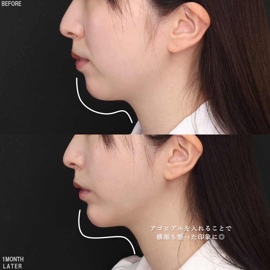 TAC式 ツヤ肌コラーゲンリフト®/Lラインファット除去（エラ下脂肪除去）/ジョールファット除去の症例写真 施術前後 