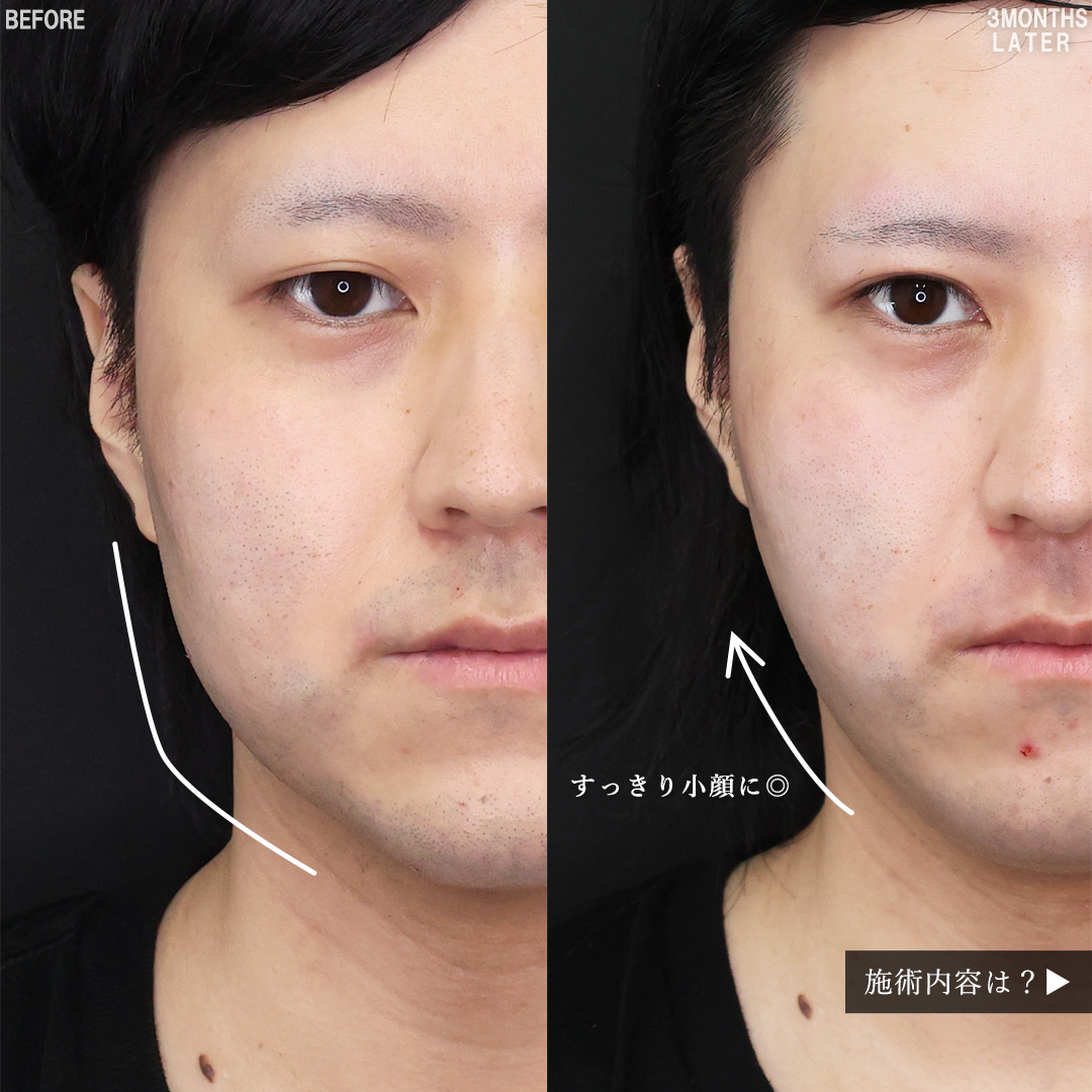 TAC式 ツヤ肌コラーゲンリフト®/メーラーファット除去/顎下の脂肪吸引の症例写真 施術前後 