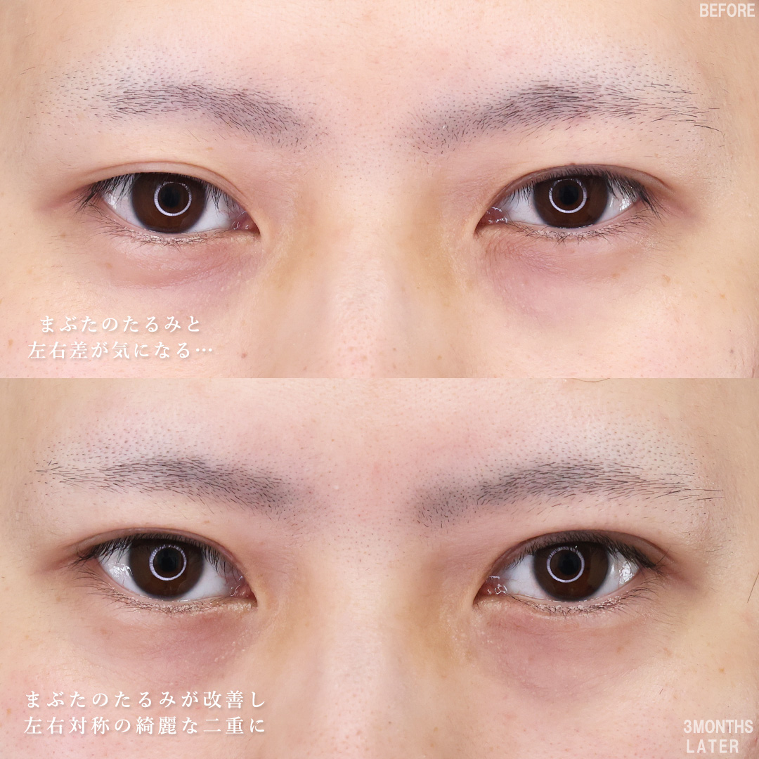 TAC式 ツヤ肌コラーゲンリフト®/メーラーファット除去/顎下の脂肪吸引の症例写真 施術前後 