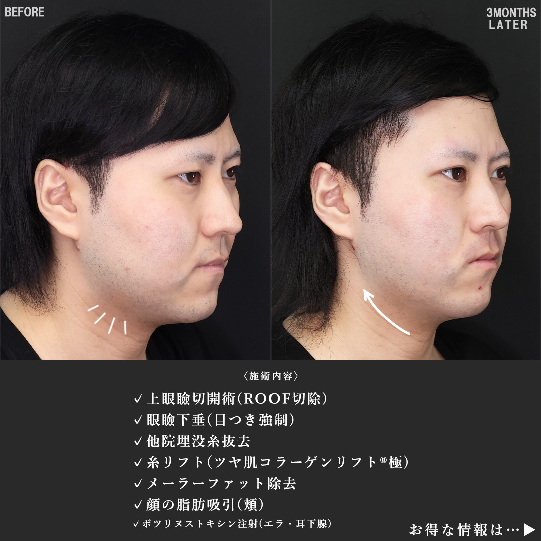 TAC式 ツヤ肌コラーゲンリフト®/メーラーファット除去/顎下の脂肪吸引の症例写真 施術前後 