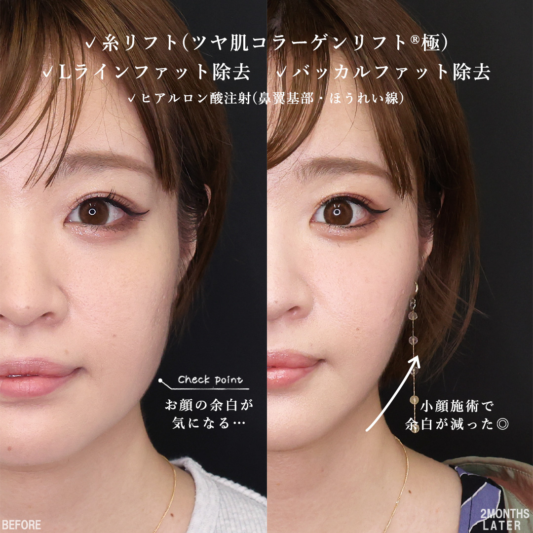 TAC式 ツヤ肌コラーゲンリフト®/バッカルファット除去/Lラインファット除去（エラ下脂肪除去）の症例写真 施術前後 