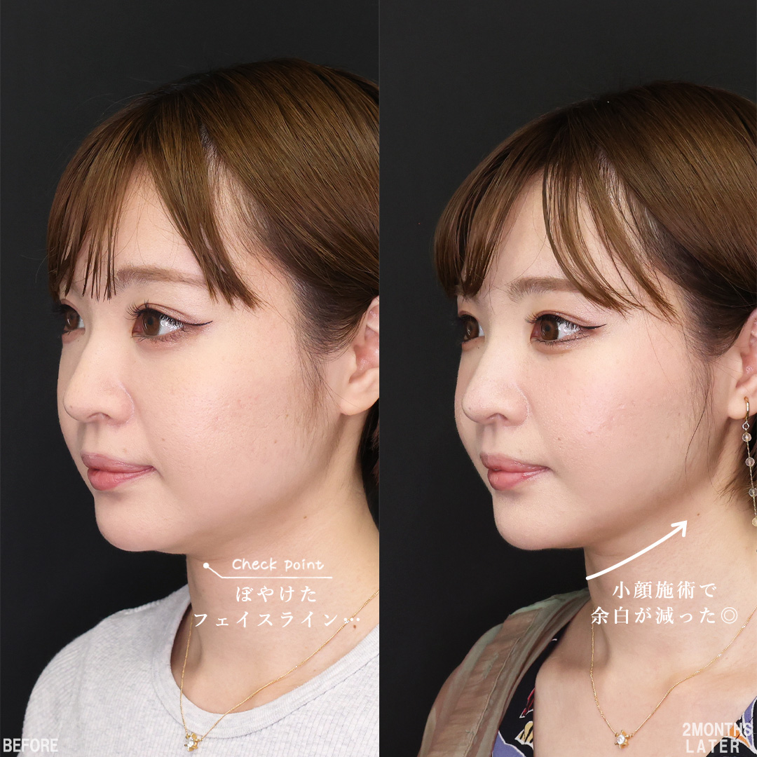 TAC式 ツヤ肌コラーゲンリフト®/バッカルファット除去/Lラインファット除去（エラ下脂肪除去）の症例写真 施術前後 