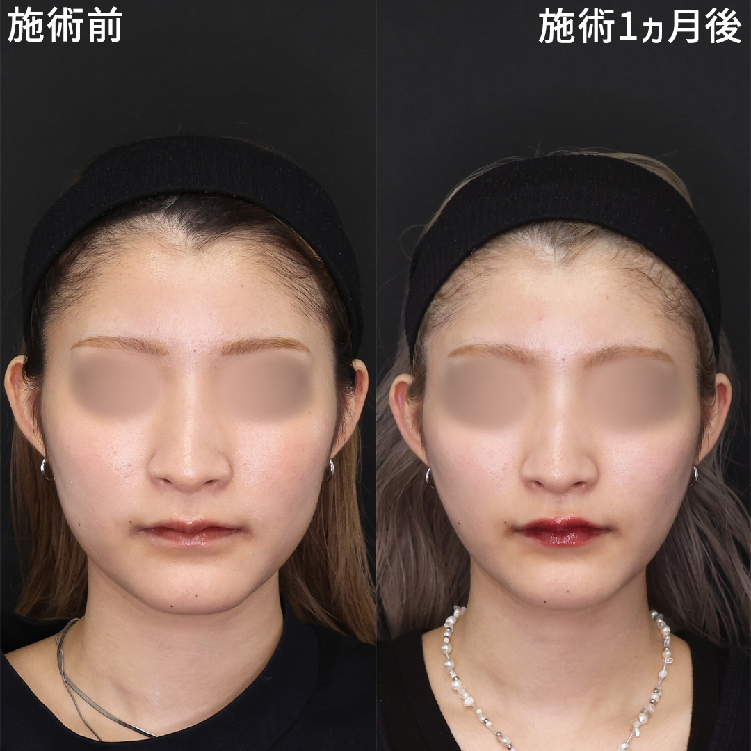 エラの張りと食いしばり対策で輪郭もスッキリ◎