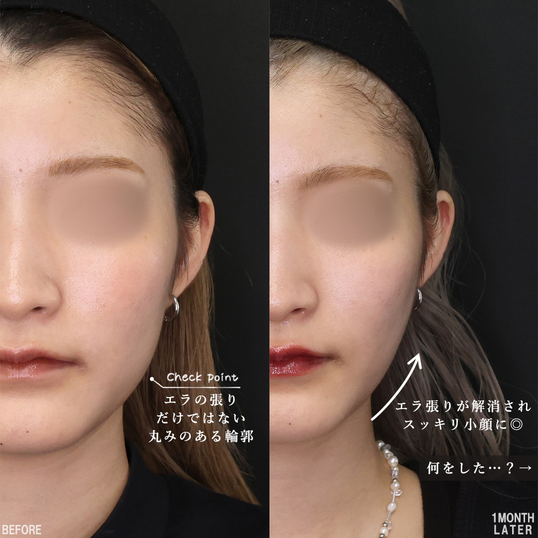 TAC式 ツヤ肌コラーゲンリフト®/Lラインファット除去（エラ下脂肪除去）/エラボトックス注射の症例写真 施術前後 