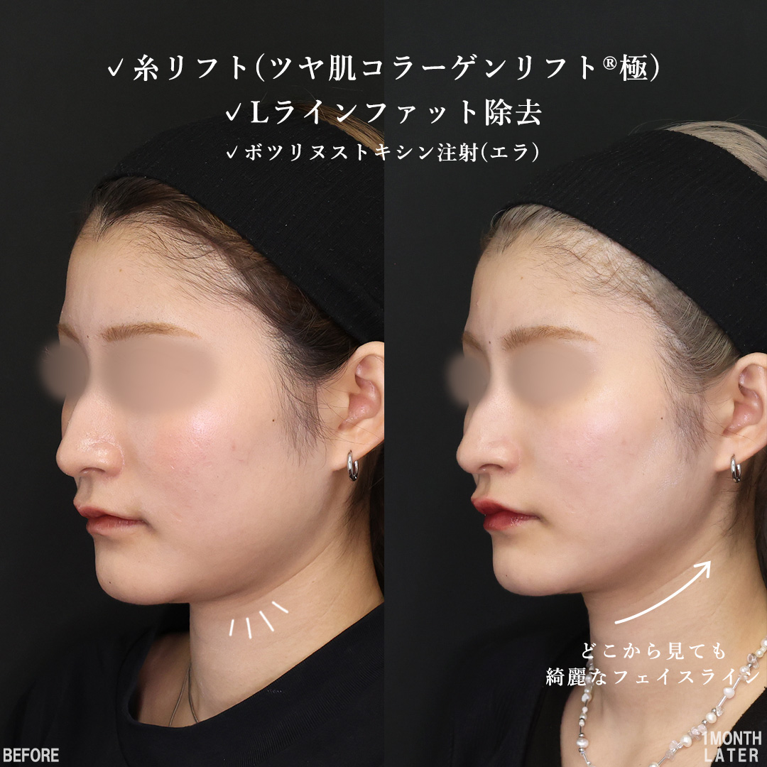 TAC式 ツヤ肌コラーゲンリフト®/Lラインファット除去（エラ下脂肪除去）/エラボトックス注射の症例写真 施術前後 