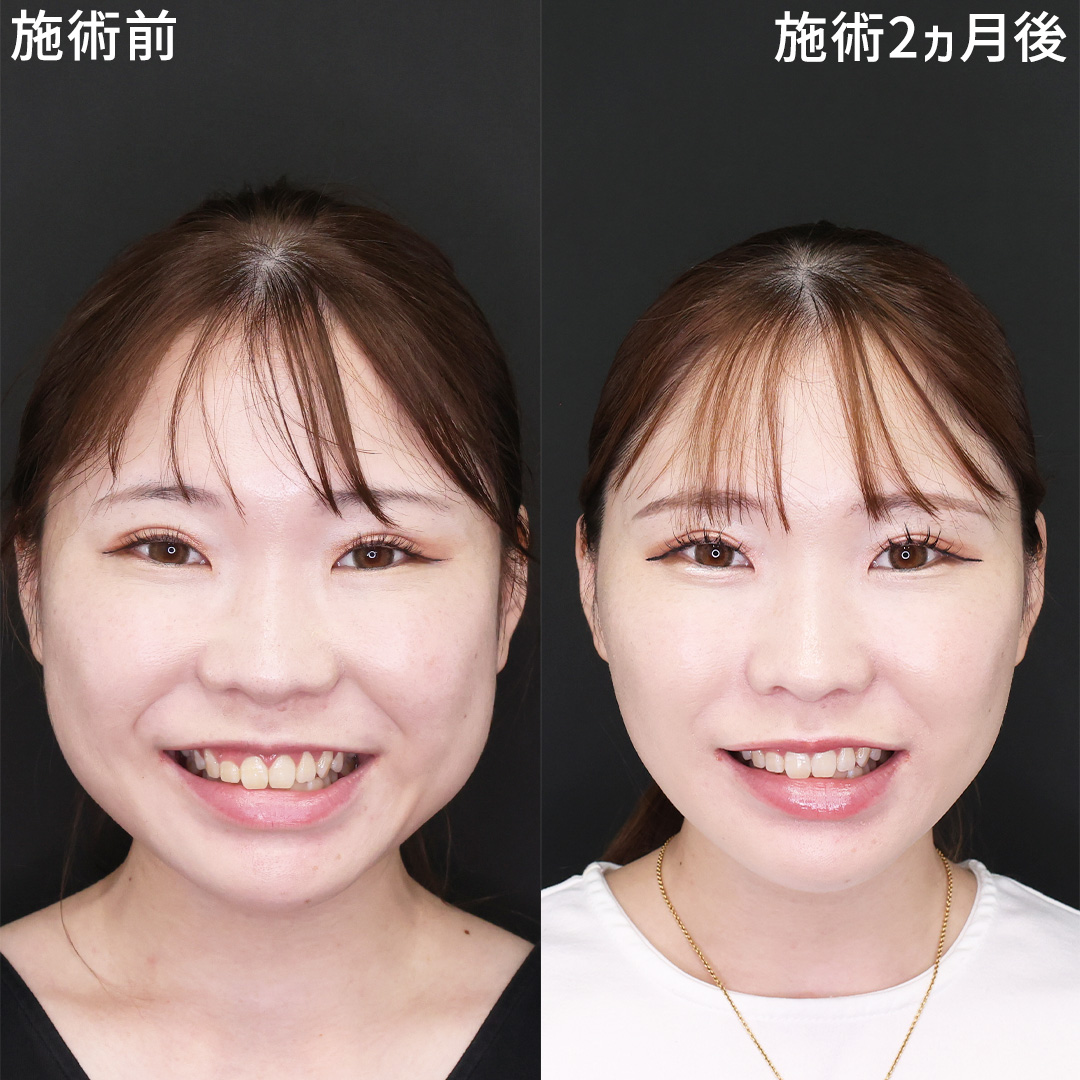 【頬肉解消】糸リフト×脂肪除去で叶える、笑顔に自信が持てる小顔に