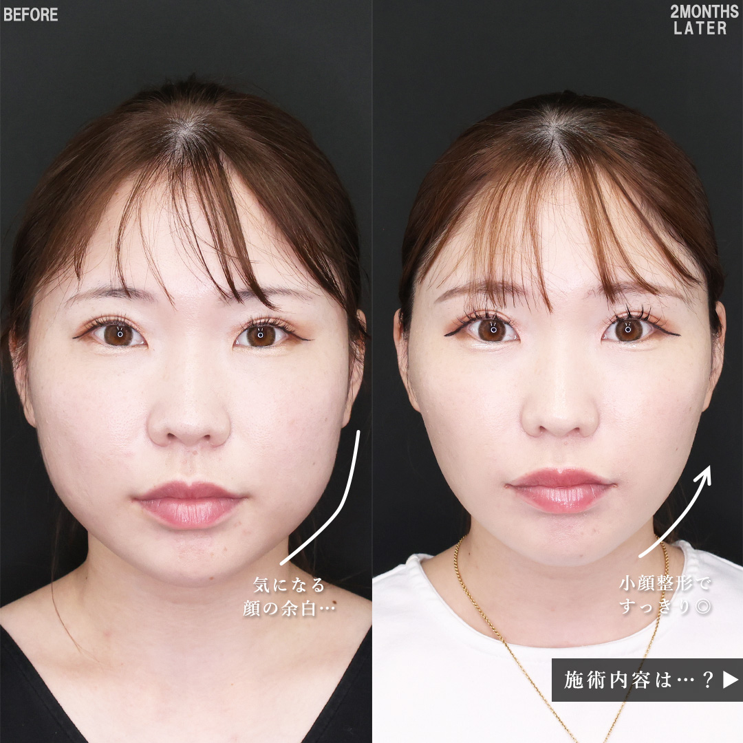 TAC式 ツヤ肌コラーゲンリフト®/ジョールファット除去/バッカルファット除去の症例写真 施術前後 