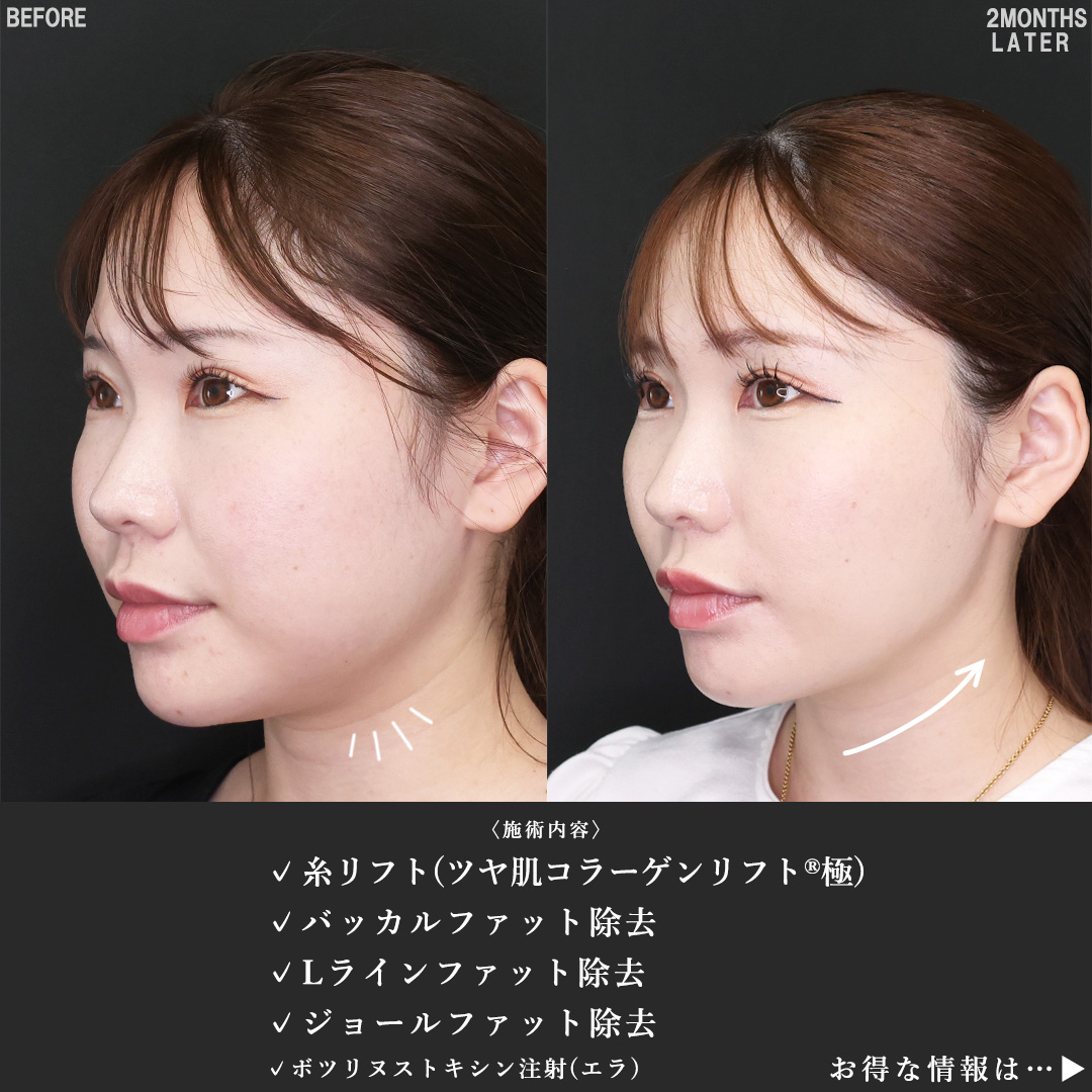 TAC式 ツヤ肌コラーゲンリフト®/ジョールファット除去/バッカルファット除去の症例写真 施術前後 