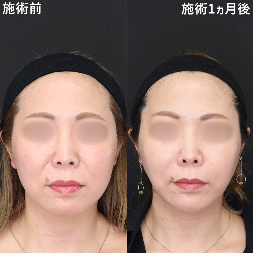 【40代女性】糸リフト×ヒアルロン酸で若返り＆美しいフェイスラインへ