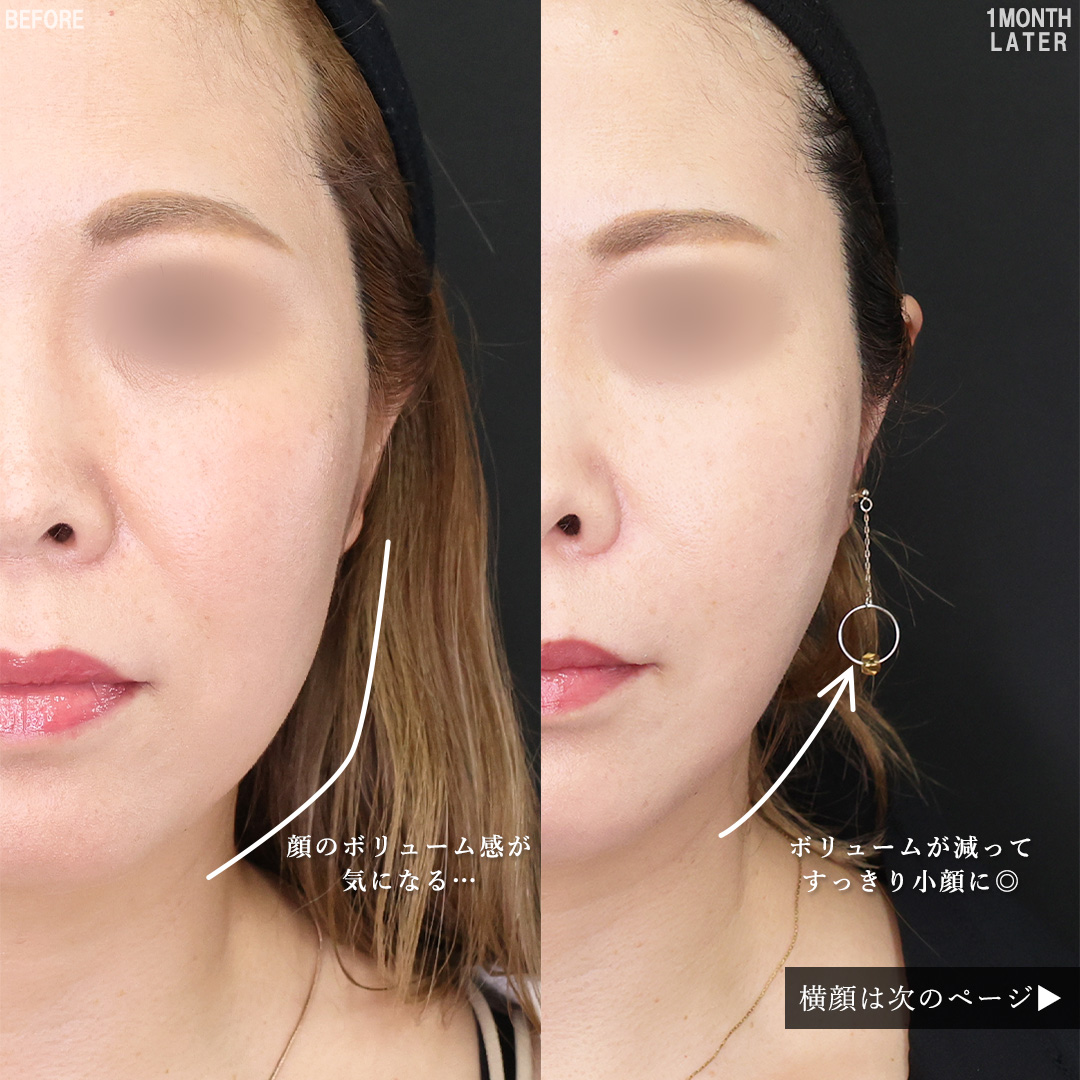 TAC式 ツヤ肌コラーゲンリフト®/Lラインファット除去（エラ下脂肪除去）/ほうれい線のヒアルロン酸注射の症例写真 施術前後 