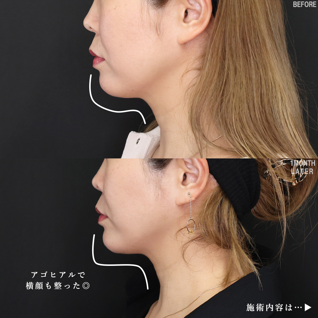 TAC式 ツヤ肌コラーゲンリフト®/Lラインファット除去（エラ下脂肪除去）/ほうれい線のヒアルロン酸注射の症例写真 施術前後 