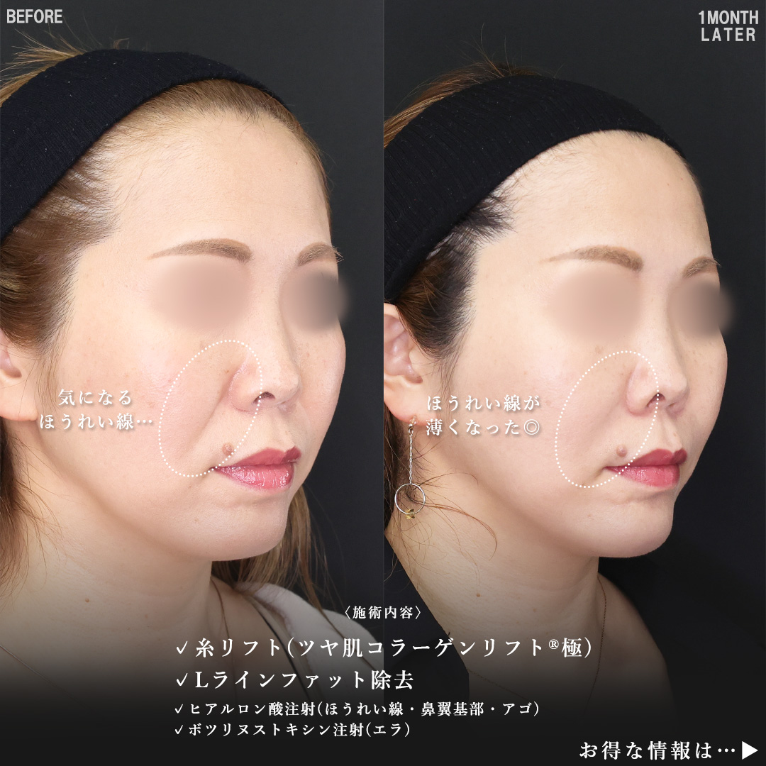 TAC式 ツヤ肌コラーゲンリフト®/Lラインファット除去（エラ下脂肪除去）/ほうれい線のヒアルロン酸注射の症例写真 施術前後 
