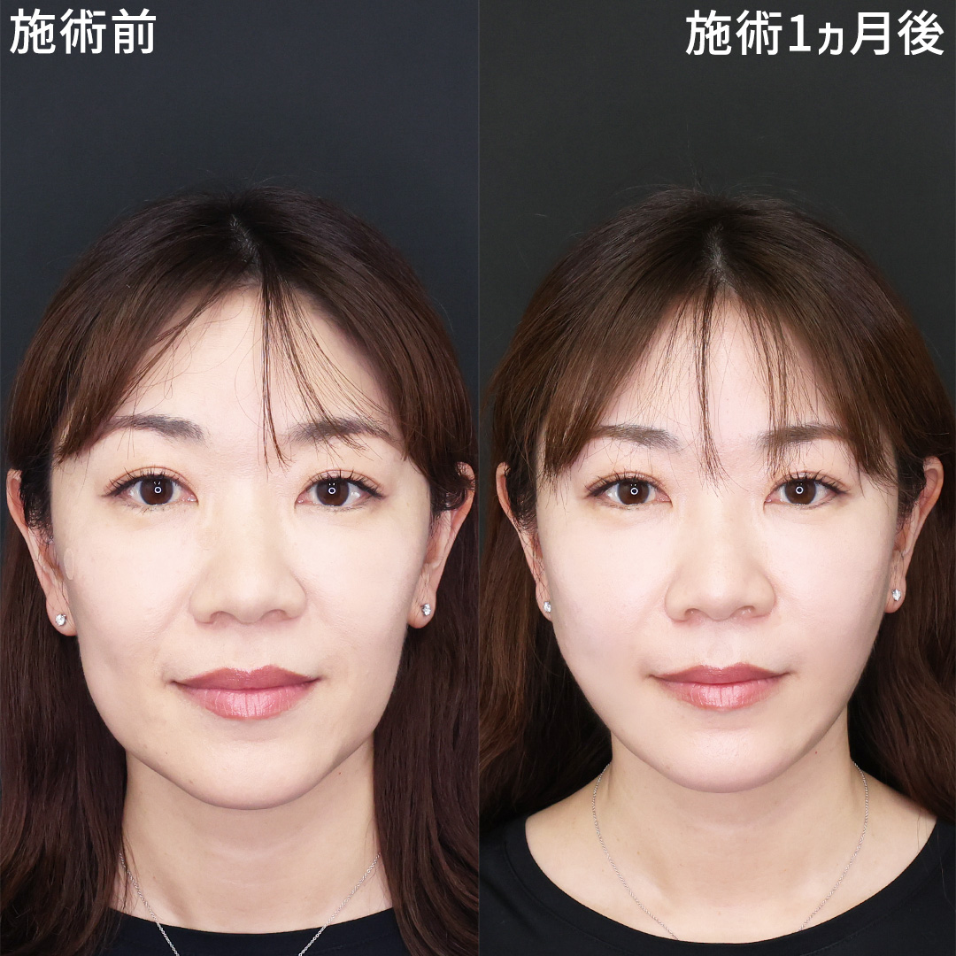 たるみと頬コケ解消で若返り！40代女性のエイジングケア