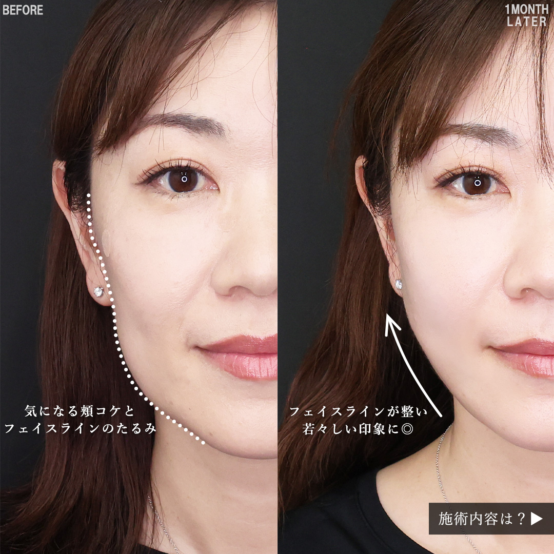 TAC式 ツヤ肌コラーゲンリフト®/Lラインファット除去（エラ下脂肪除去）/顔の脂肪吸引の症例写真 施術前後 