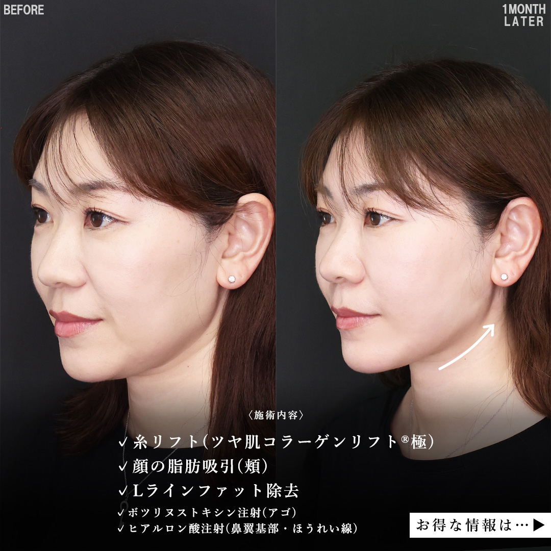 TAC式 ツヤ肌コラーゲンリフト®/Lラインファット除去（エラ下脂肪除去）/顔の脂肪吸引の症例写真 施術前後 