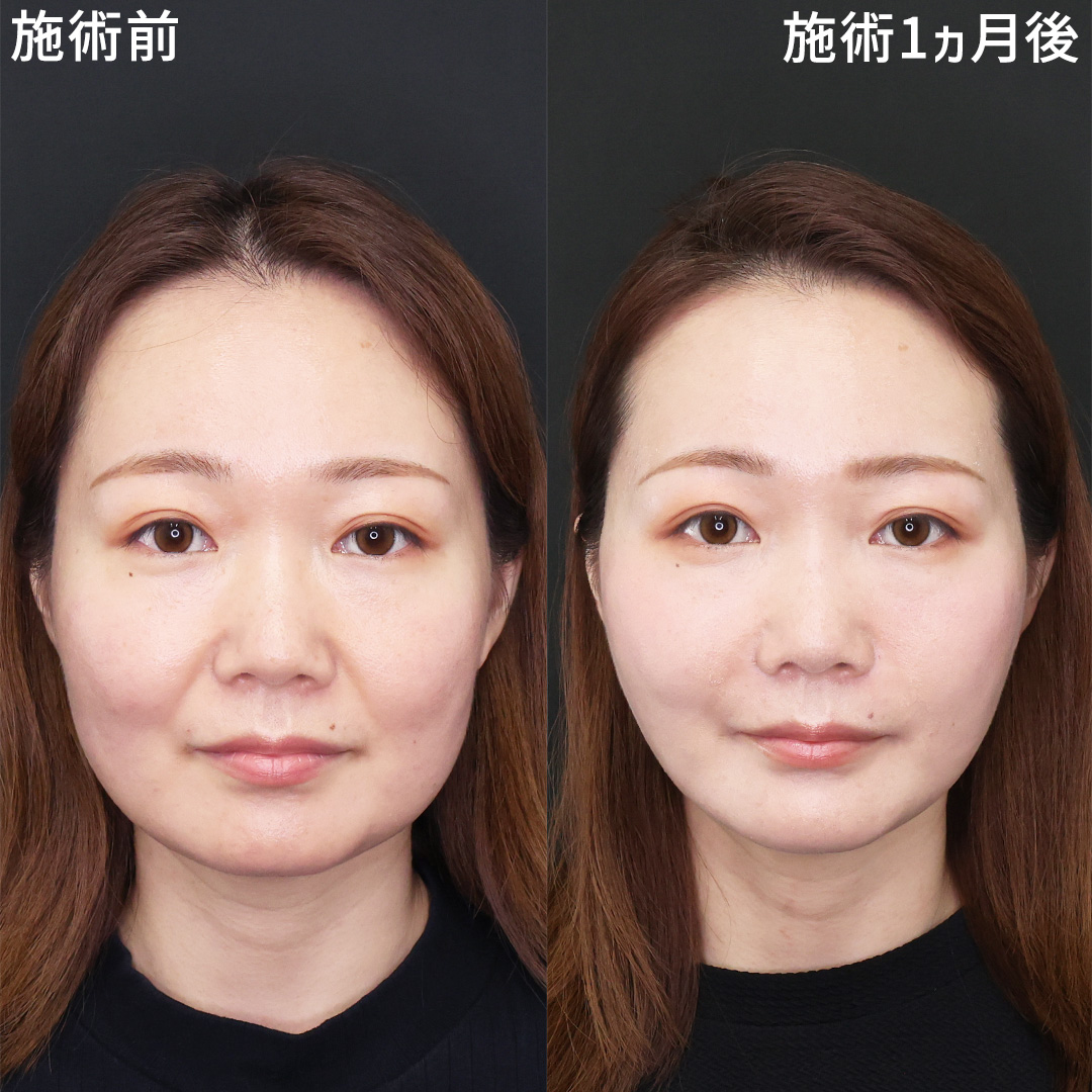 法令線解消で-10歳若返り！