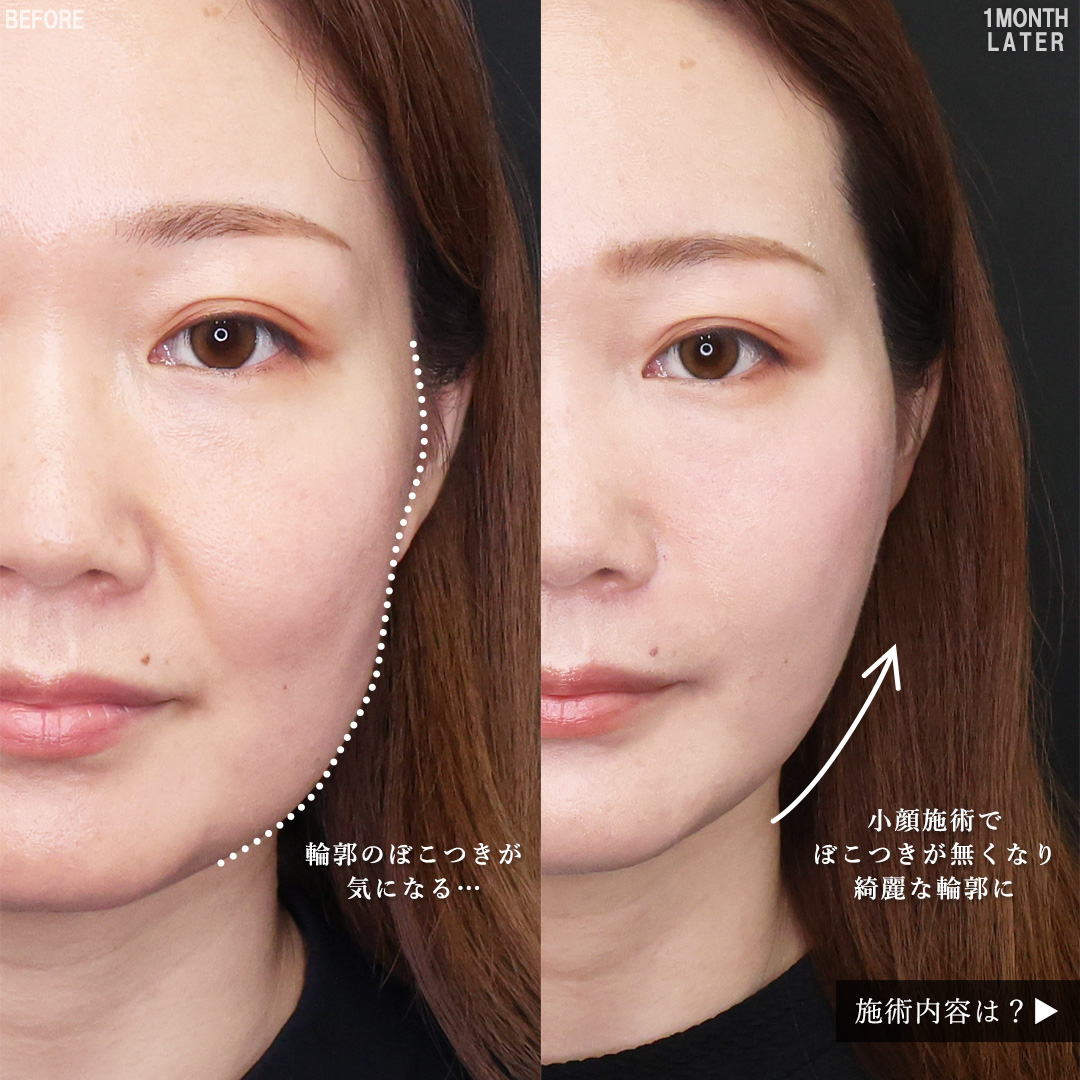 TAC式 ツヤ肌コラーゲンリフト®/メーラーファット除去/Lラインファット除去（エラ下脂肪除去）の症例写真 施術前後 