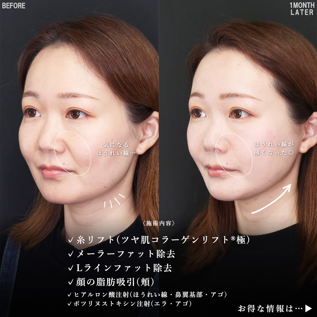TAC式 ツヤ肌コラーゲンリフト®/メーラーファット除去/Lラインファット除去（エラ下脂肪除去）の症例写真 施術前後 