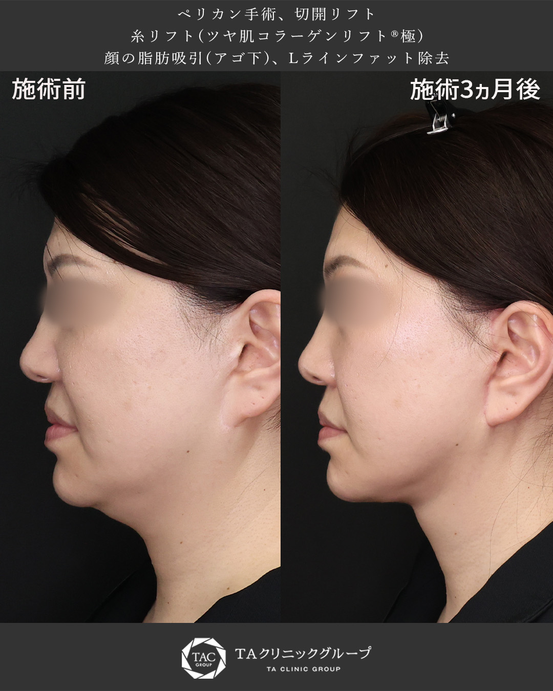 【二重アゴ解消】ペリカン手術+切開リフトで-10歳若返り◎
